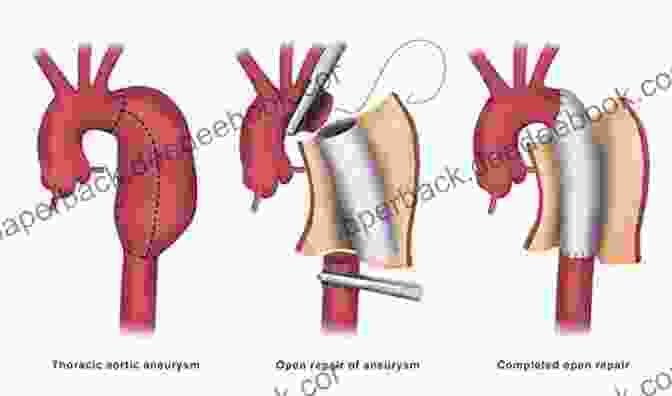 Atlas Of Advanced Endoaortic Surgery: A Comprehensive Guide To Complex Aortic Procedures Atlas Of Advanced Endoaortic Surgery