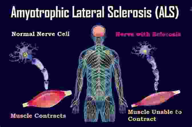 Image Representing The Unexpected Relationship Between Amyotrophic Lateral Sclerosis (ALS) And Autism Spectrum Disorder (ASD) Cindy Erica S Obsession To Solve Today S Health Care Crisis: Autism Alzheimer S Disease Cardiovascular Disease ALS And More